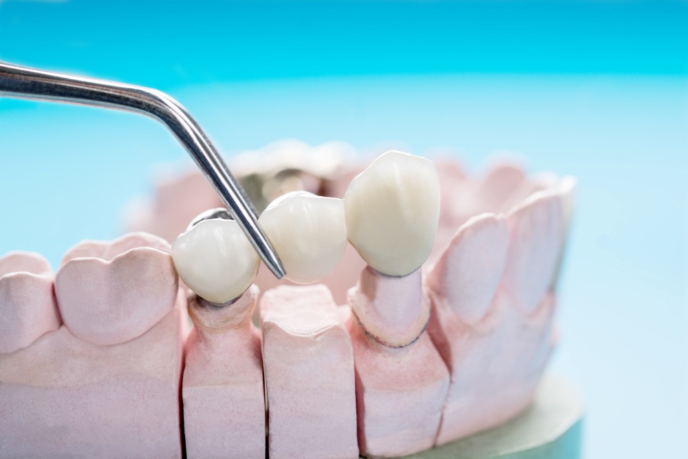 dental bridge in turkey