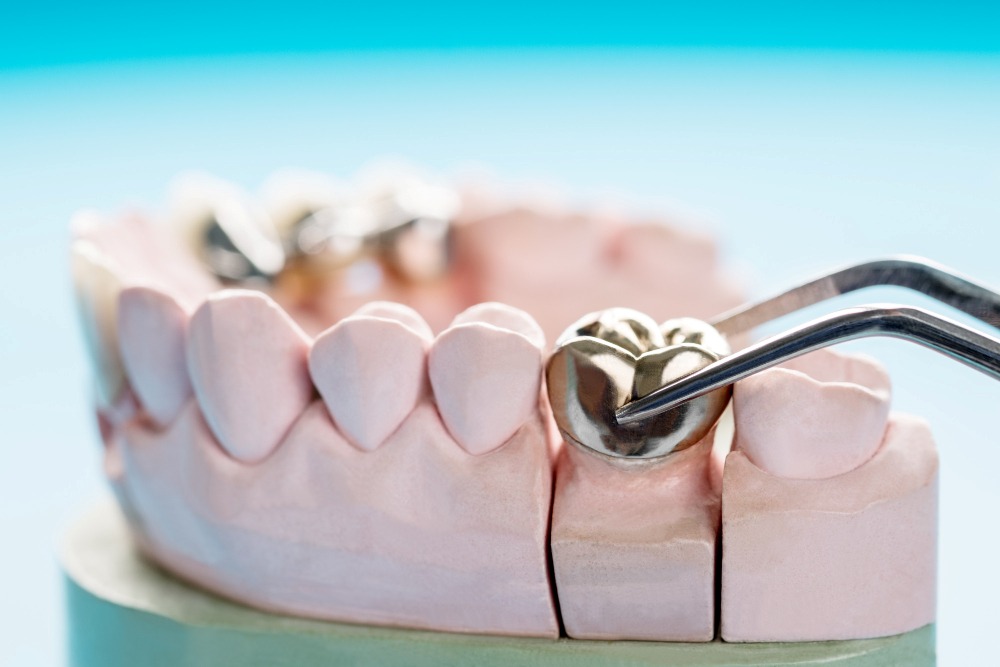 dental bridge