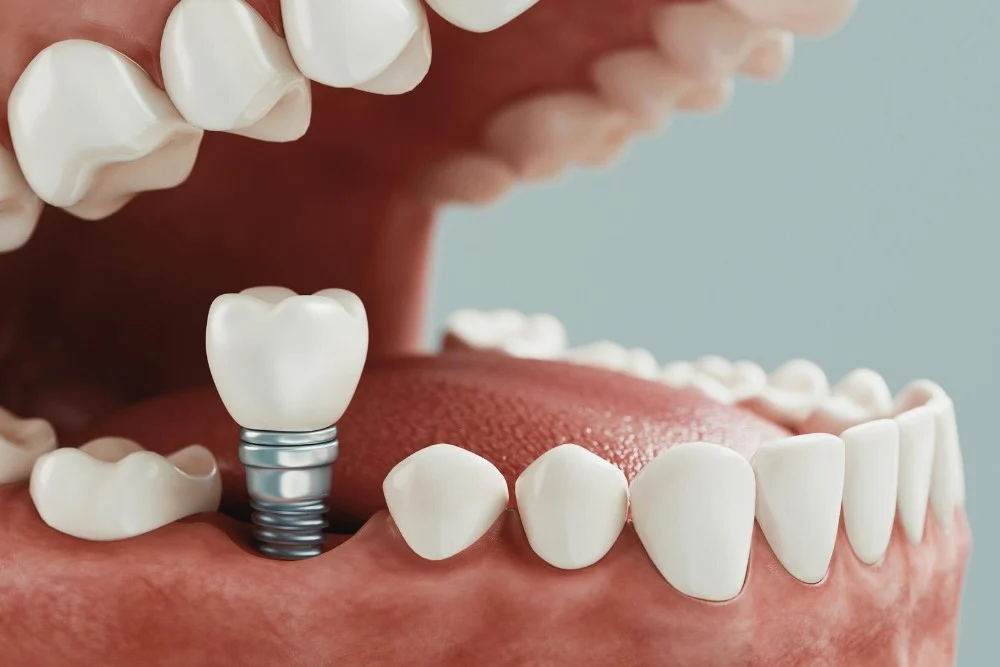 dental implants in turkey
